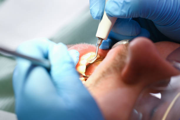 Best Knocked-Out Tooth (Avulsed Tooth) Treatment in Steelville, MO