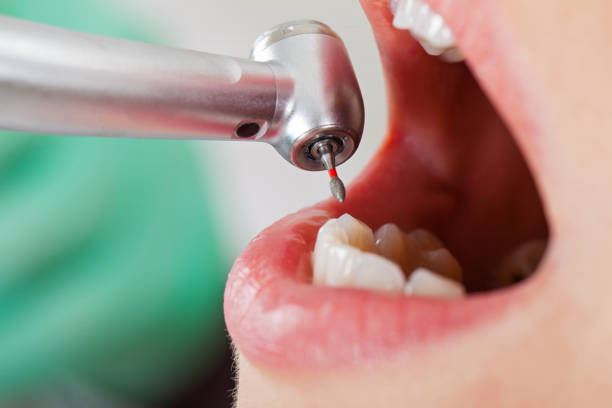 Best Emergency Root Canal Therapy in Steelville, MO